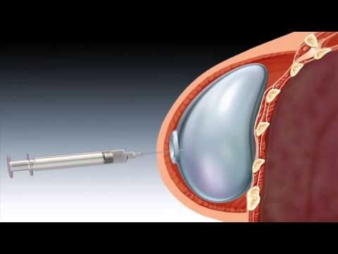 What is a Tissue Expander _ Breast Reconstruction Overview