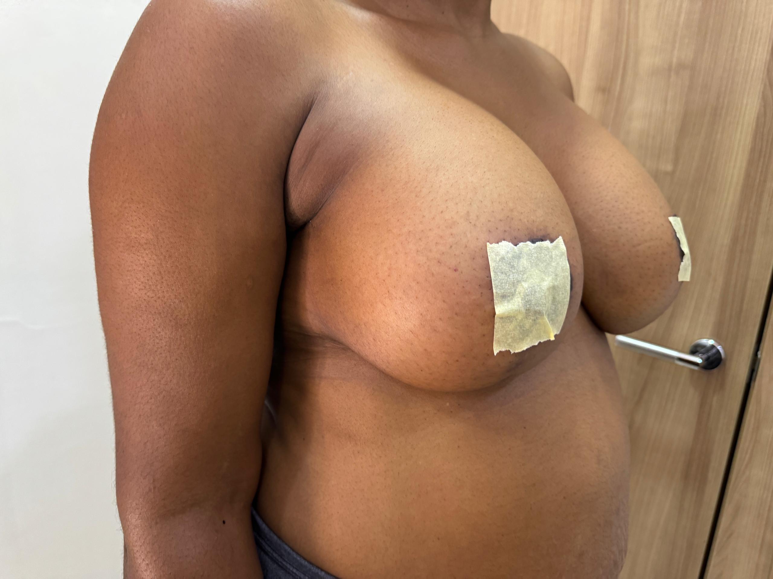 Breast Reduction Surgery - Body Code Aesthetics